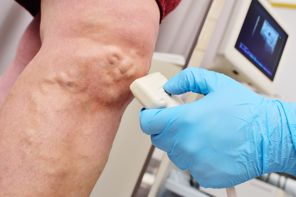 Doctor scanning varicose veins with ultrasound